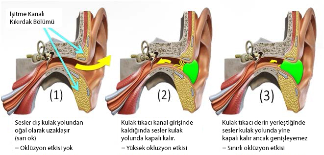 Kulak tıkacı oklüzyon etkisi